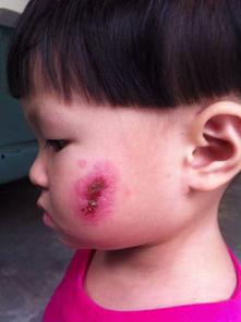 脸上的疤图片,探寻脸庞印记的深刻寓意